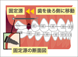 インプラントアンカー図解