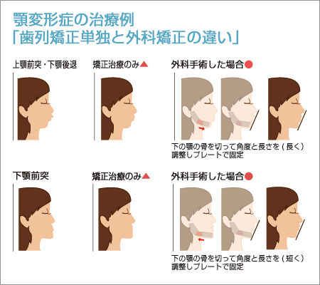 顎変形症の治療例　「歯列矯正単独と外科矯正の違い」