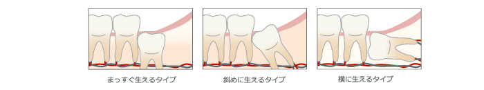 親知らずのタイプは様々です