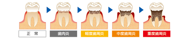 歯周病の進行具合