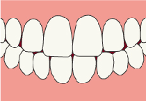 正常な歯茎