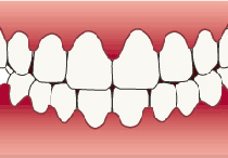 歯肉炎になっている歯茎