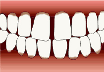重度歯周病の歯茎